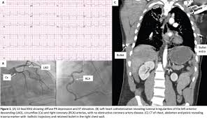Image result for Cardiac Contusion