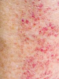 Image result for allergy rash on the legs