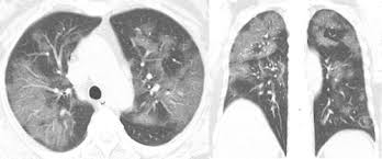 Maybe you would like to learn more about one of these? Severe Covid 19 Pneumonia Assessing Inflammation Burden With Volume Rendered Chest Ct Radiology Cardiothoracic Imaging
