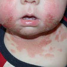 Pictures Of Skin Allergies In Children