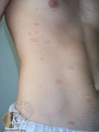 Men jeg lurer veldig på hva det kan være. Det Rode Udslaet Laeger Formidler