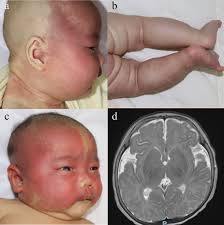 Somatic mutation spectrum of a Chinese cohort of pediatrics with vascular  malformations