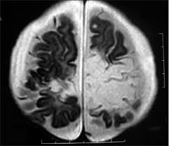In addition, it was observed in various pathological conditions: Poor Neurological Sequelae Of Herpes Simplex Virus Encephalitis In An Infant Despite Adequate Antiviral And Adjunct Corticosteroid Therapy Basak Rb Malpani V Kakish K Vargese S Chauhan N Boeck A Indian