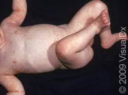 Image result for scabies human children