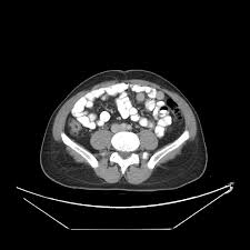 Pdf) Laparoscopic Management Of Mobile Cecum