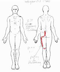 Clinical Presentation Of Sacroiliac Pain