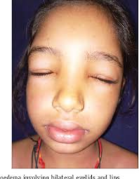 Urticaria and Angioedema Associated with Haloperidol
