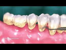 1 Scaling And Root Planing Youtube Invisalign Dentist Dental Check Up Invisalign