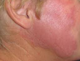 This response creates inflammation in many parts of the body, including the joints,. Cutaneous Lupus Erythematosus Dermnet Nz