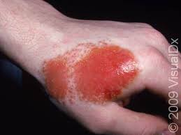 Image result for dermatitis contacta children