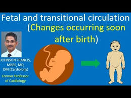 Image result for Delayed Transition from Fetal Circulation