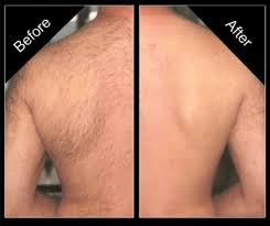 Thinking About Hair Removal Here S How To Shave Your Back For Men Back Hair Removal Hair Removal For Men Laser Hair Removal Treatment