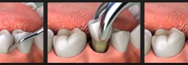 Dr akan periksa samada korg alami simptom sebelum ni, dan risiko kemungkinan terjadinya komplikasi, sebelum buat keputusan. Cabut Gigi Teeth Tooth