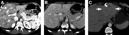 Imaging Approach For Evaluation Of Focal Liver Lesions Clinical Gastroenterology And Hepatology