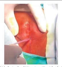 Image result for Labial Fusion