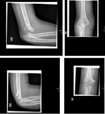 01.10.2018 · paediatric medial humeral epicondyle (mhe) fracture management is one of the most controversial topics in paediatric fracture care. Journal Of Medical And Psychological Trauma Open Access Pub