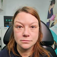 3 bölgeye Botox bir de 1 ml dudak dolgusu ile değişim! Transforming beauty  in the heart of London! 💫 Witness the stunning before and after of our  fabulous client who indulged in