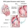 pfo symptoms in adults from my.clevelandclinic.org