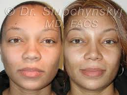 A blackhead having roots deep down your skin, when forcibly picked can not only damage your skin pores, but tips to prevent and remove blackheads on your nose. Pin On Got Face