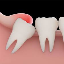 An experienced dentist will be able to remove your wisdom teeth with no problems thereby preventing inflammation and infection, overcrowding. Wisdom Teeth Removal Cost Uk Recovery Time Pain Relief Faq Electric Teeth
