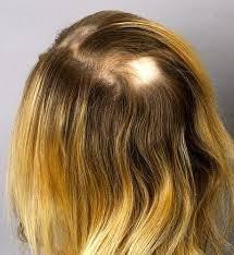 Alopecia is the medical term for hair loss. Ù…Ø§ Ù‡Ùˆ Ø¯Ø§Ø¡ Ø§Ù„Ø«Ø¹Ù„Ø¨Ø© Ø§Ù„Ø¨Ù‚Ø¹ÙŠØ© Alopecia Areata Ellearabia