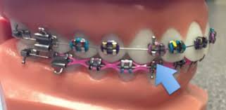 You can cut the thin wire. Braces Emergencies Break Your Permanent Retainer Firouz Orthodontic