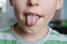 Image result for Puchýře na jazyku