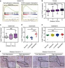 Grading is an important part of the evaluation of your prostate cancer. Depression Promotes Prostate Cancer Invasion And Metastasis Via A Sympathetic Camp Fak Signaling Pathway Oncogene