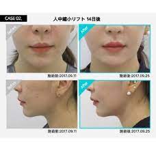 人中手術 これからは人中短縮リフトでしょ 人中 クリニック リフト