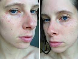 My House Was Poisoning Me And I Had No Idea Rash On Face Mold Exposure Black Mold Symptoms