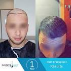 زراعة الشعر في تركيا " مركز انفينتي هير " لزراعة الشعر في اسطنبول