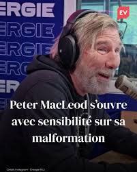 Peter MacLeod s'est montré très vulnérable à la radio en évoquant sa  malformation. L'humoriste aborde rarement le sujet. Voici les détails :  https://www.noovomoi.ca/en-vedette/peter-macleod -malformation-discussion.html