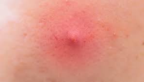 How can i get rid of it? Armpit Pimple Types Causes And Treatments