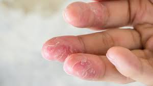 Image result for Contact Dermatitis