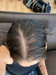 Genetic types of hair loss include alopecia areata and female pattern hair loss. Female Pattern Hair Loss At 29 Femalehairloss