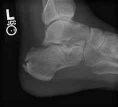 Image result for Calcaneus Compression Fracture
