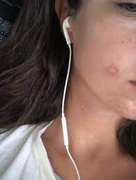 Cela peut être dû à une mauvaise habitude alimentaire ou encore à un trouble hormonal. Bouton Sous Peau Persistants Acne Journal Des Femmes