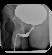 Image result for Voiding Cystourethrogram