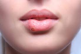 This is the same virus that causes chickenpox. Herpes Ursachen Symptome Behandlung Und Sonderformen Erklart