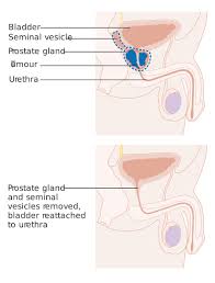 Image result for Radical Prostatectomy