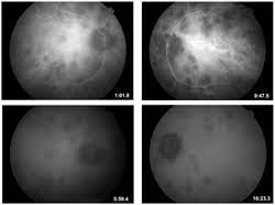 Diagnosis And Treatment Of Bsrc