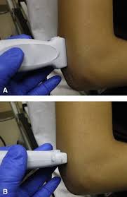 Image result for Elbow Joint Injection
