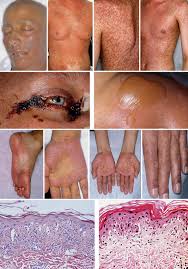 Enfermedad crónica de injerto contra huésped: Caracteristicas De La Eich