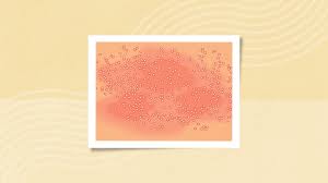 Image result for koebner phenomenon psoriasis