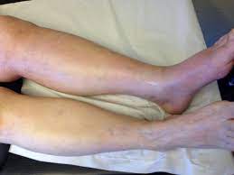 We did not find results for: Sintomas De La Trombosis Trombo Info