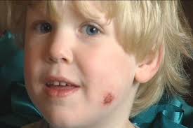 Mother: teacher tried to remove temporary tattoo with cleaning pad