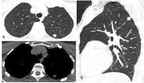 Prior ldct scans are useful because they can reveal an abnormal growth rate of lung nodules, thus indicating malignancy. A And B Low Dose Computed Tomography Ldct Sections Show 11 Mm Solid Download Scientific Diagram