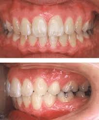 Jul 01, 2021 · a comprehensive database of more than 13 pediatric nursing quizzes online, test your knowledge with pediatric nursing quiz questions. Orthodontic Gallery Dentist Edina Mn Dental Education Library