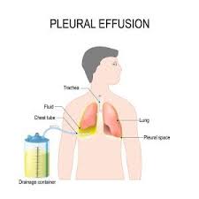 The classic description of malignant pleural mesothelioma is a thickening in the pleural space with encasement of the lung by a rindlike . Pleural Mesothelioma Mesothelioma Attorneys At Napoli Shkolnik Pllc