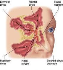 صورة ذات صلة Polyp Sinus Polyps How To Stay Healthy